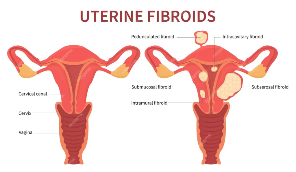 Fibroid Uterus Treatment