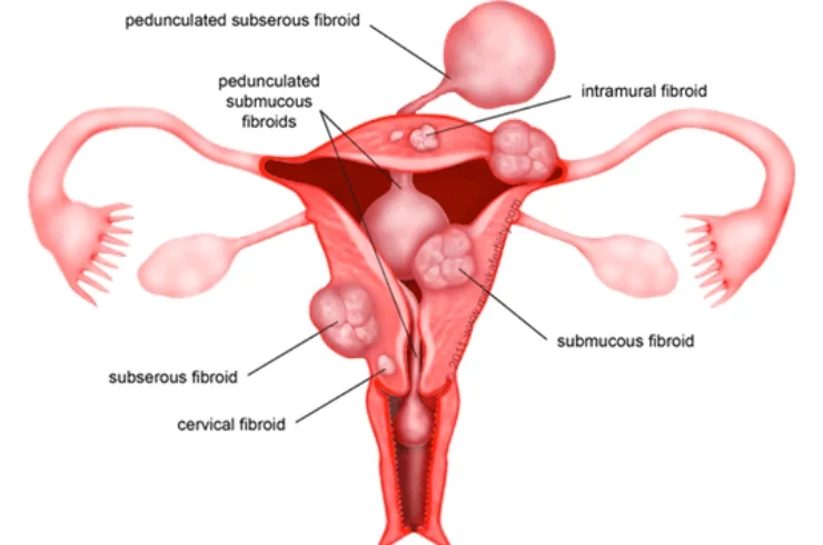 laparoscopic Myomectomy-------14