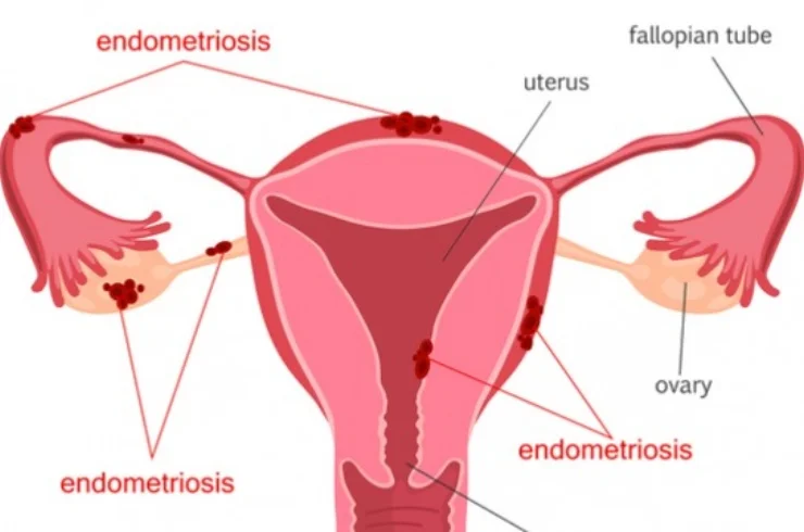 Endometriosis Surgeries