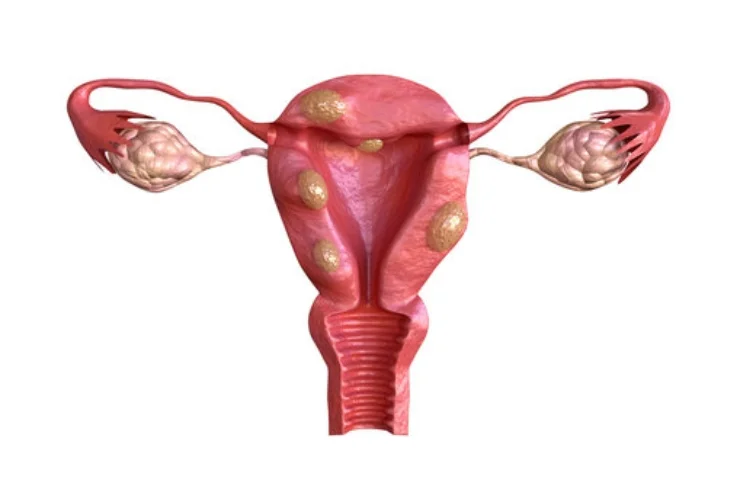 Fibroid Uterus Treatment