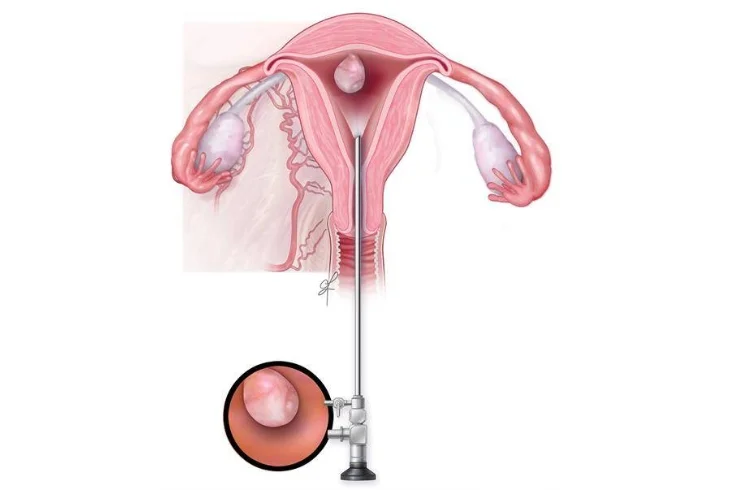 Hysteroscopic Fibroid Removal