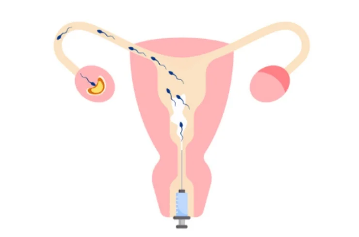 IUI (Intrauterine Insemination)