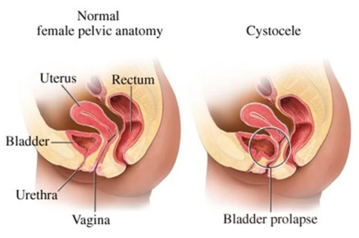 Prolapse Management------16