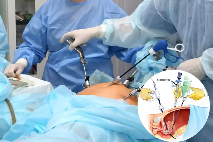 laparoscopic-gii-endometrisis-repair-681dfbc753fbe